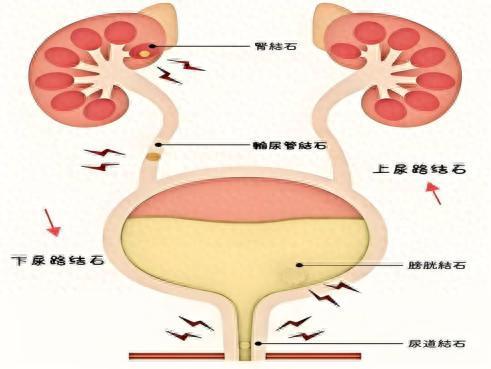 大牛网 永医科普丨泌尿系结石那些事儿